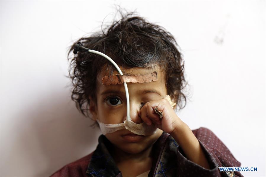 YEMEN-SANAA-CHILDREN-MALNUTRITION